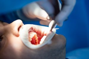 Invisalign Treatment