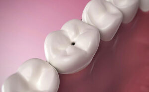 Black Spot on a Tooth