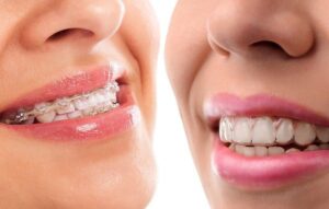 Clear Braces Vs. Clear Aligners