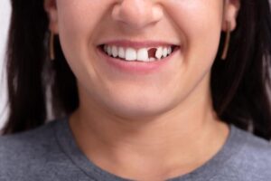 Options for Replacing a Missing Tooth