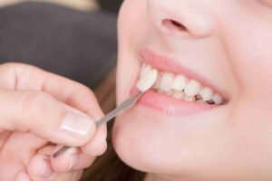 Porcelain Veneers in Hamilton