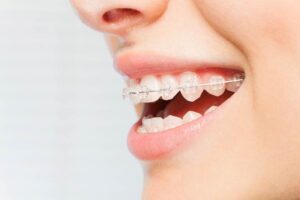 clear braces ancaster