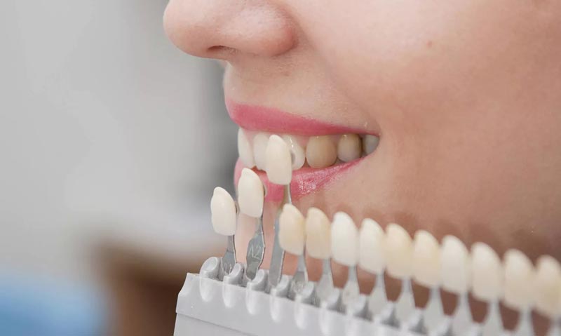 find best dentist for veneers