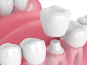 Reasons You Need to Get a Dental Crown