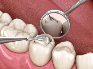 Types of Dental Fillings: A Quick Guide