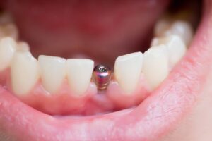 What is the Process of Getting Dental Implants