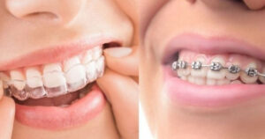 Invisalign vs. Braces