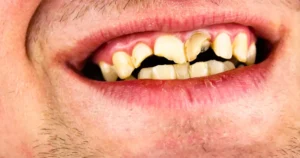 a picture of a man with Cavity on a Front Teeth