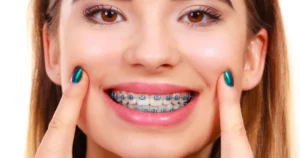 A picture of a woman showing her braces
