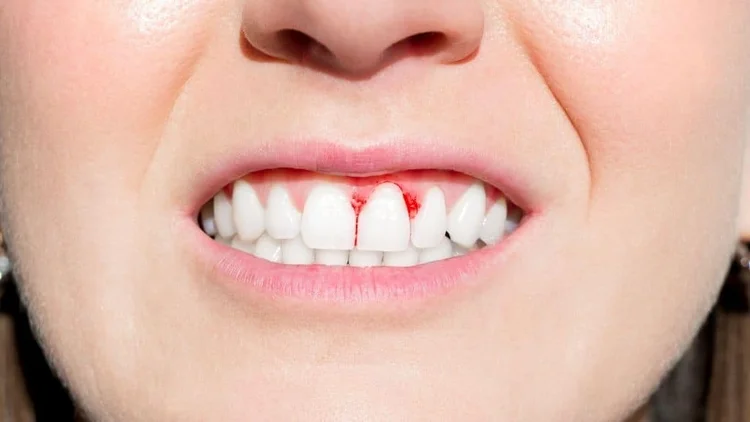 A picture of a lady with Loose Gum Flap Between Teeth
