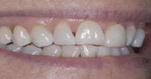 A picture of a patient's gums