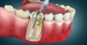 A picture demonstrating tooth sensitivity
