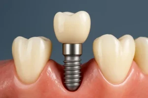 What are screwless dental implants