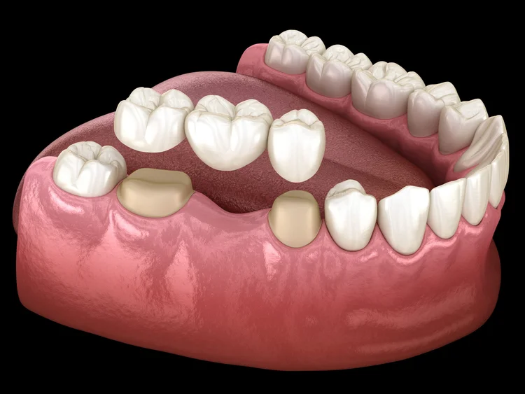 A picture demonstarting the structure of dental crowns