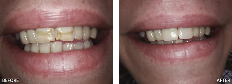 A before and after picture of whitened fillings