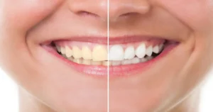 A before and after picture of teeth whitening